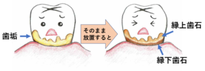 歯垢と歯石の違いについて | まごころ歯科ブログ