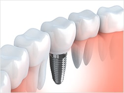 インプラントは最も機能的に優れた欠損歯の治療法