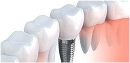 歯を守るためのインプラント治療